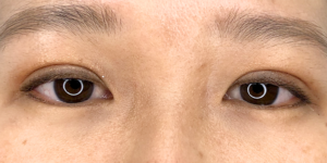 28 [Instant Double Eyelid Surgery]